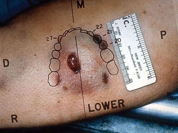 Human bite wound analysed