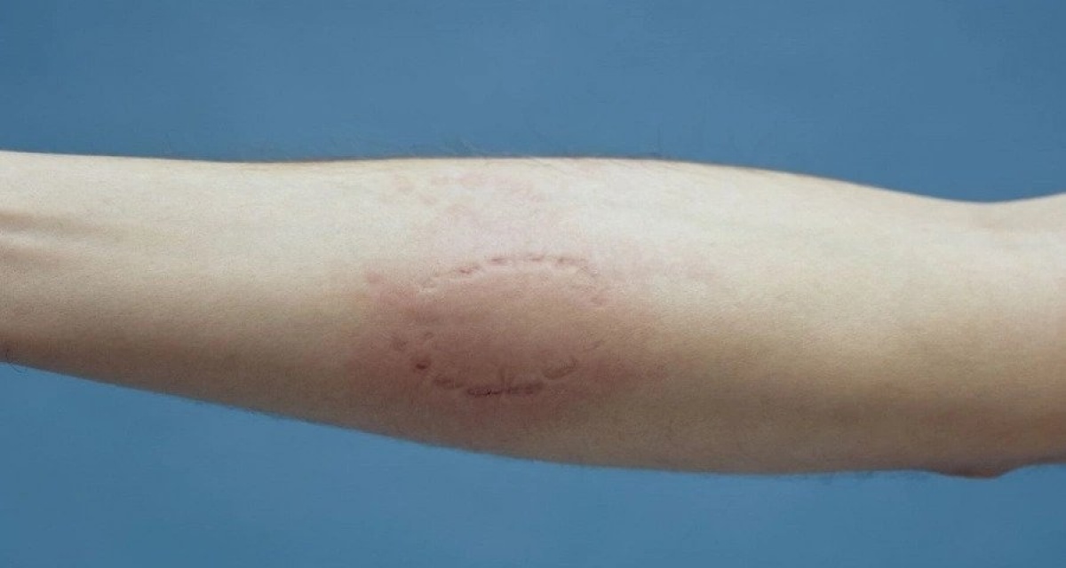 How To Tell If A Human Bite Wound Is Infected 